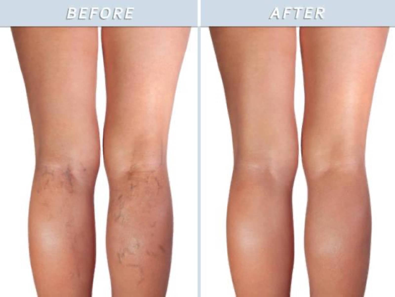 Before and after results of an optimized vein treatment program
